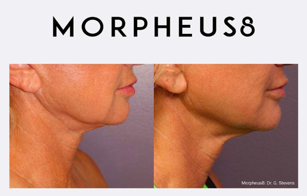 Morpheus8 before and after