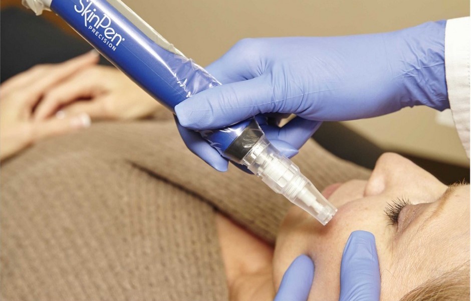 You are currently viewing The Benefits of Microneedling: A Comprehensive Guide