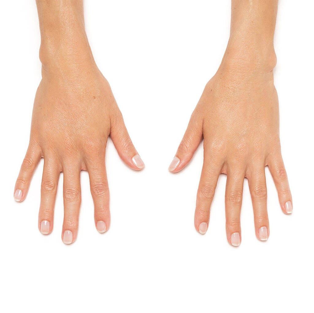 Hand Rejuvenation After